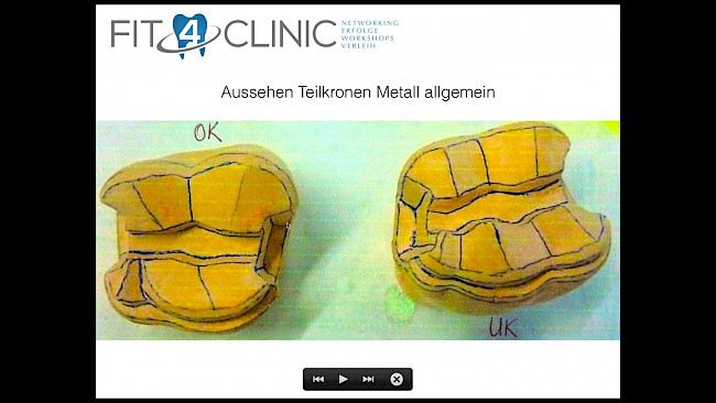 Präsentation Teilkrone Schritte