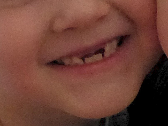 ausgeschlagene Zähne
