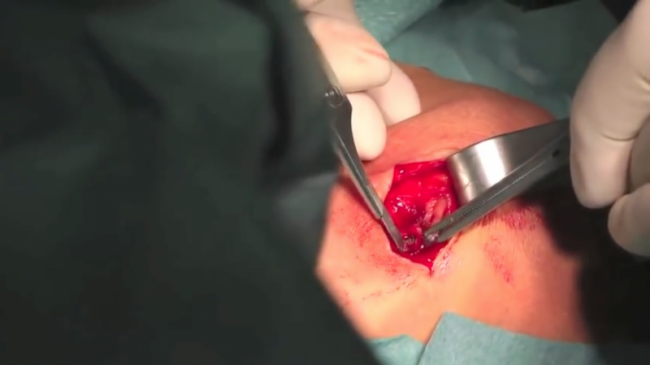 Operation nur in Hypnose