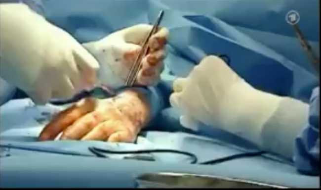 Hypnose statt Narkose 2