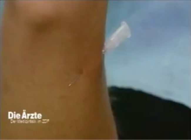 Hypnose statt Narkose