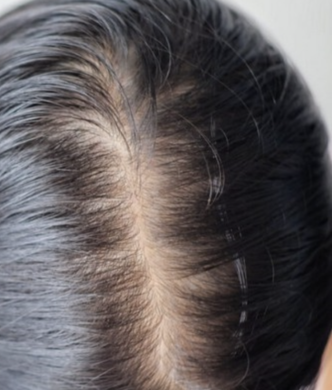 Stressbedingter Haarausfall