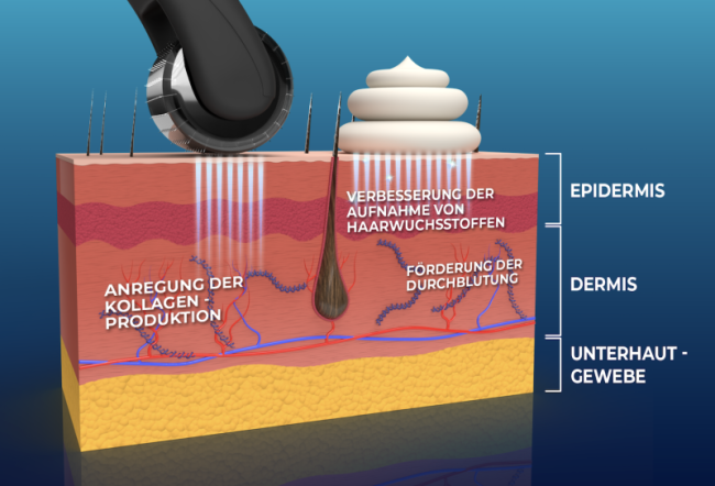 Die Wirkung unseres Dermarollers