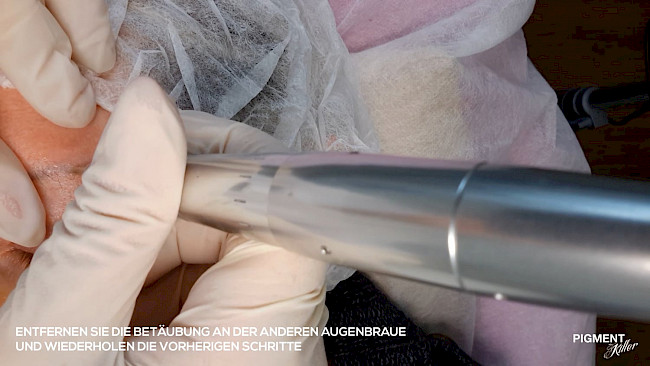 Schulungsvideo - Pigment Killer mit PMU Maschine