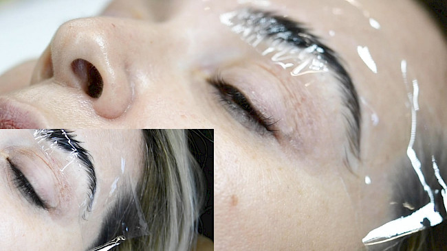 Brow Lifting Praxis Modell 1