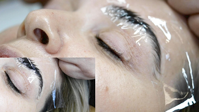 Brow Lifting Praxis Modell 1