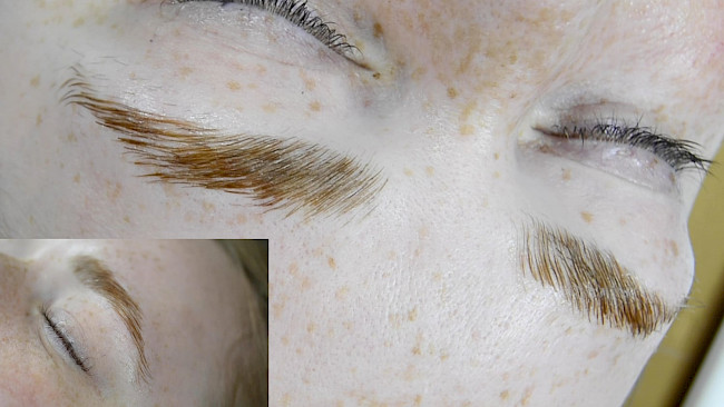 Brow Lifting Praxis Modell 2