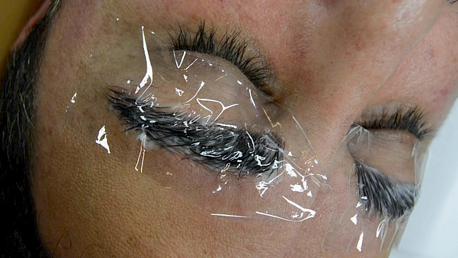 Brow Lifting Praxis männl. Modell 1