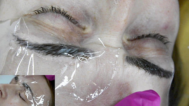 Brow Lifting Praxis Modell 3