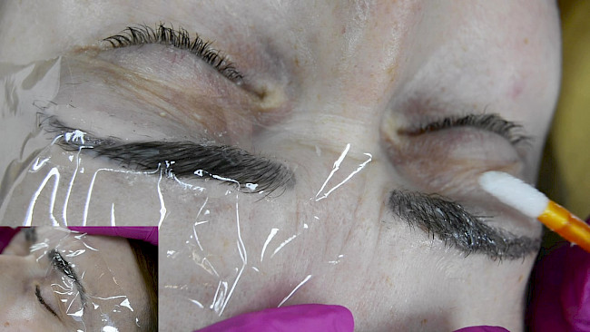 Brow Lifting Praxis Modell 3